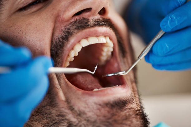 Best Emergency Wisdom Teeth Removal in Prospect, PA